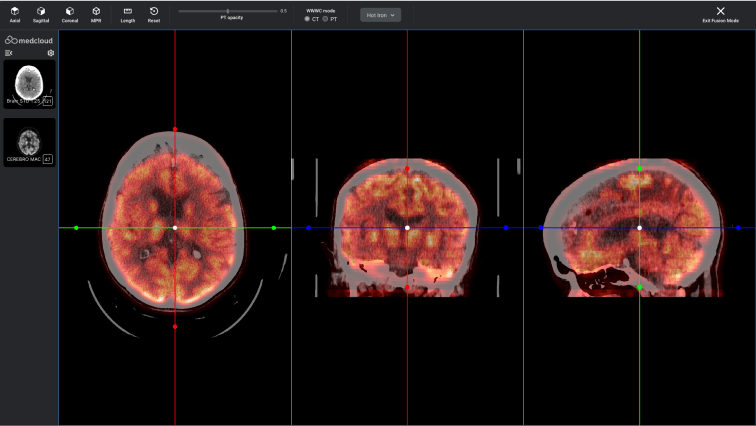 PET-CT